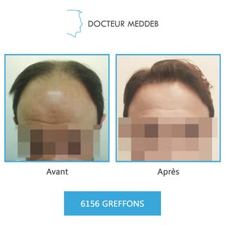 NW 5 - 37 ans - 6156 Greffons 

Diamètre des cheveux : 60 microns
Densité zone donneuse : 72 UF/cm²
