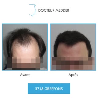 NW 5 - 36 ans - 3718 Greffons 

Diamètre des cheveux : 60 microns
Densité zone donneuse : 54 UF/cm²
