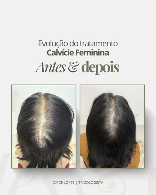 Antes e depois de um tratamento para calvície feminina. 

Repara na densidade da risca: fios mais pr