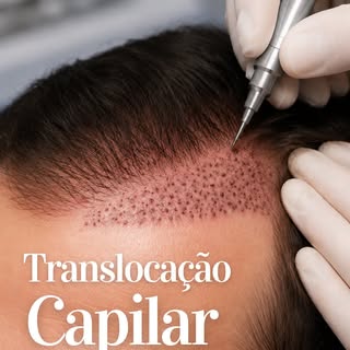 Um procedimento minimamente invasivo, realizado em consultório, que ajuda a preencher áreas estratég