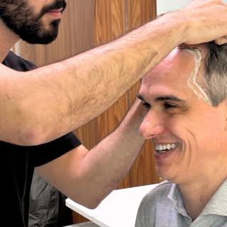Paciente após o tratamento clínico otimizado, ainda apresentava áreas de rarefação e calvície que co