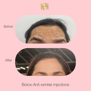 🤍Botox🤍

🤍Relax those muscles, relax those wrinkles!

🤍Botox is a quick and effective way to red
