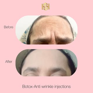 🤍Botox🤍

🤍Relax those muscles, relax those wrinkles!

🤍Botox is a quick and effective way to red