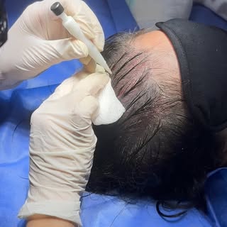 No esperes para agendar tu consulta de valoración!  Podemos realizar una video consulta. #alopecia #