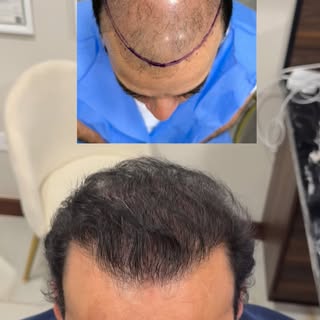 El injerto capilar fue la solución para repoblar la zona con pérdida de cabello de nuestro paciente.