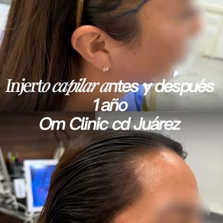 Injerto capilar 

Resultados que hablan por sí solos. ✨

Más densidad, diseño natural y una nueva co