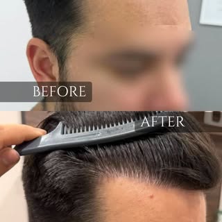 El injerto capilar para Las zonas pequeñas también hacen una gran diferencia. ✨
Precisión y naturali