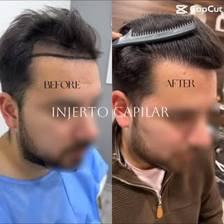El injerto capilar de alta densidad requiere una planificación precisa, respetando la anatomía, dire