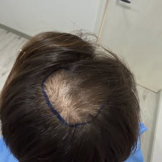 Injerto capilar en coronilla 

La naturalidad está en los detalles.
Un injerto capilar bien ejecutad