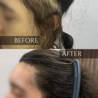 Resultados de un injerto capilar en alopecia por tracción 

Está ocurre cuando el folículo piloso ha