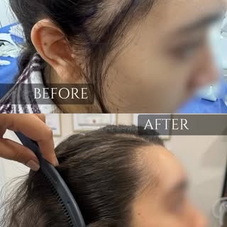 Resultados de un injerto capilar en alopecia por tracción 

Está ocurre cuando el folículo piloso ha