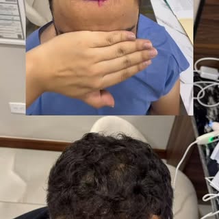 Antes y después injerto capilar 
Resultados reales.
Un injerto capilar exitoso no solo devuelve cabe