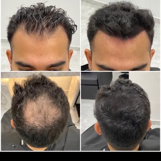 Work of art, a mix of Scalp Micropigmentation and Hair Microblaidng, this client was so happy with h
