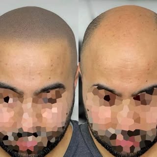 Before & Scalp Micro-pigmentation.
Instant guaranteed results. 
Price ranges from $1000-$3500