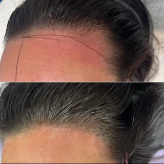 Before & After Hair Microblading.
Price ranges from $1000-$3000
Dm for a free consultation