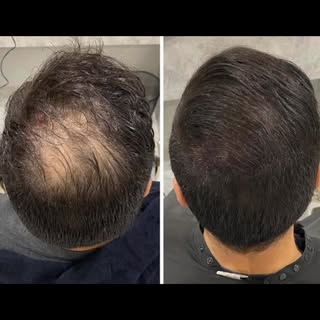 Before & After Scalp Micropigmentation