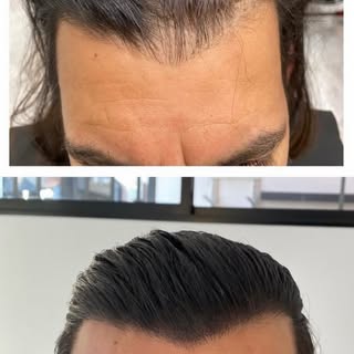 This client had both Hair Microblading and Scalp Micro-pigmentation. Which includes stroking for the