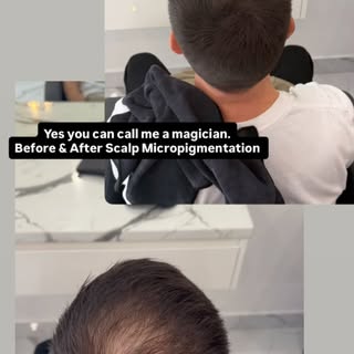 Before & After Scalp Micropigmentation 
Instant guaranteed results 
Price range from $1000-$3500
Loc
