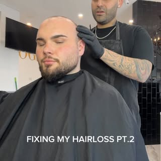 Part 2: The Scalp Micro-Pigmentation (SMP) Transformation
I can’t wait to show you guys the final re