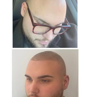 Before & After Scalp Micro-Pigmentation. We also offer Hair Microblading, Beard & Eyebrow Microbladi