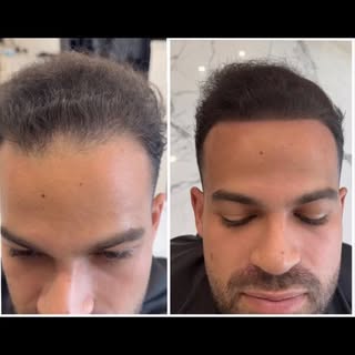 Before & After Scalp Micropigmentation & Hair Microblading.
Instant guaranteed results. Price ranges