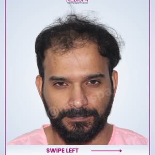 Hair Transplant Results with Dr Suneet Soni at Medispa

How do Experts create Density without Over H