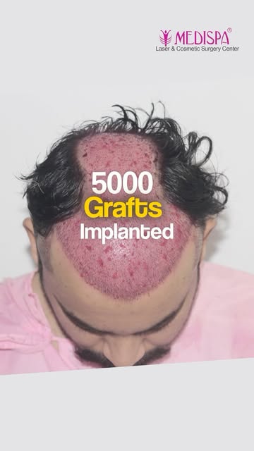 5000 Grafts Hair Transplant: 6-Month Results | Dr Suneet Soni

Book your consultation now:

👉 𝐂𝐚�