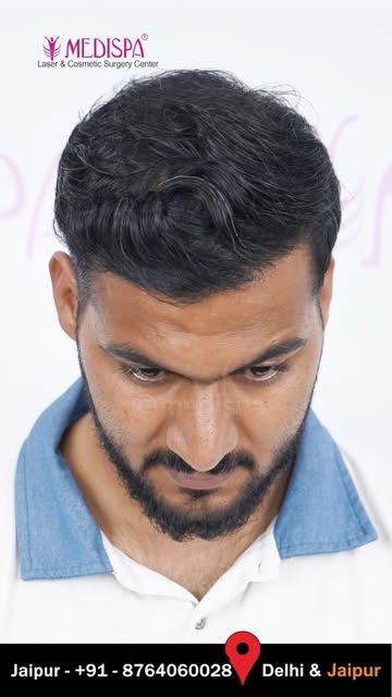 High Density Hair Transplant Results | Dr Suneet Soni

Book your consultation now:

👉 𝐂𝐚𝐥𝐥: +91