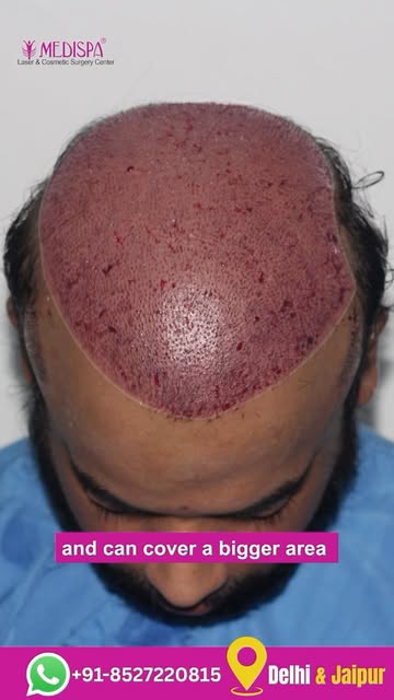 5000 Grafts from Limited Donor Area | Grade 6 Hair Transplant Results | one Day Procedure | Fusion G