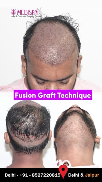 4500 Grafts | Grade 5 | Hair Transplant Results | One Day Procedure | Dr Suneet Soni

Book your cons