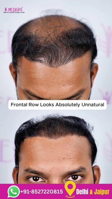Bad Hair Transplant Results Can Ruin Your Confidence | Choose Your Surgeon Wisely

Book your consult