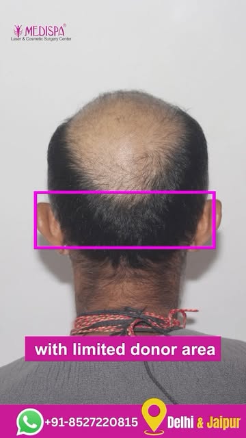5000 Grafts in ONE Sitting | Grade 6 Hair Transplant Results | Dr Suneet Soni

Book your consultatio