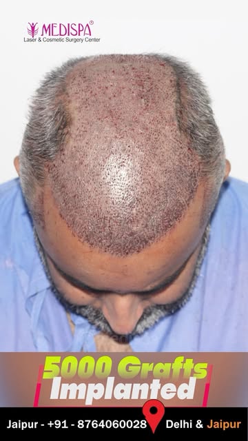 Grade 6 to This Result | 5000 Grafts Hair Transplant | Dr Suneet Soni

Book your consultation now:

