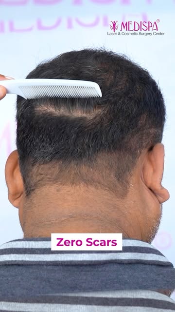 5000 Grafts in One Day | Grade 6 Hair Transplant | 7-Month Results | Dr Suneet Soni

Book your consu