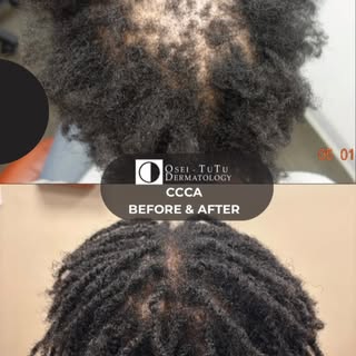Stay Encouraged 💪🏾

#Ccca #scarringalopecia #naturalhair #hairloss #alopecia