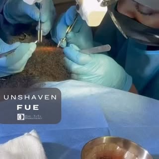 #hairtransplant does not always have to involve shaving!
———
Long hair, preview unshaven #fue is a g