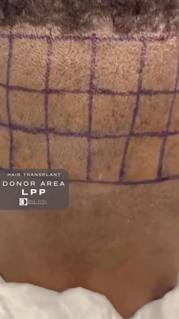 Compromised donor quality is always a concern when considering Hair transplantation in patients with