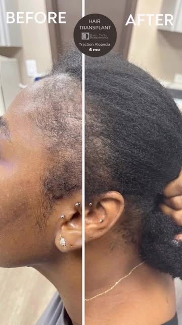 #beforeandafter #hairtransplant #tractionalopecia 

———-
✅ 6 months post-op

After years of inconsis