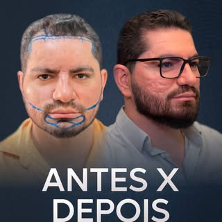 Tive o prazer de realizar o transplante capilar e de barba do Dr. Saulo Monteiro.
No dia da cirurgia