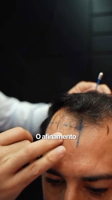 Transplante capilar começa muito antes da cirurgia.

Avaliação, planejamento da linha frontal e defi