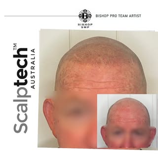 3rd session and redness to subside.
No more hats for this guy 🙌🏻

⭐️⭐️⭐️⭐️⭐️ REVIEWS

TRUST EXPERI