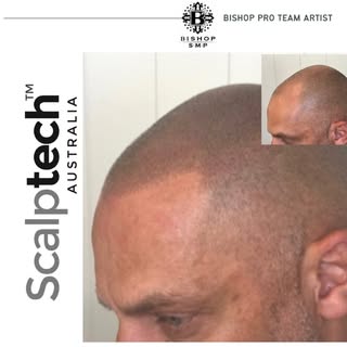 3rd session…

⭐️ 12years as SMP practitioner/artist
⭐️ FREE Consultation 
⭐️ BISHOP sponsored artist