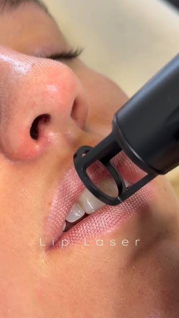 ⚡️Lip Laser uses laser technology to target both the surface and deeper layers of the lips, promotin