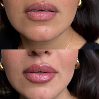 Balanced proportion, softened edges, and hydrated volume—no overfilling, just precision. 💉 👄