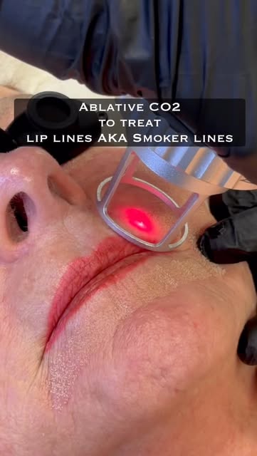 Lip lines, softened.
CO2 laser resurfacing to smooth, refine, and restore.
Physician-performed. Natu