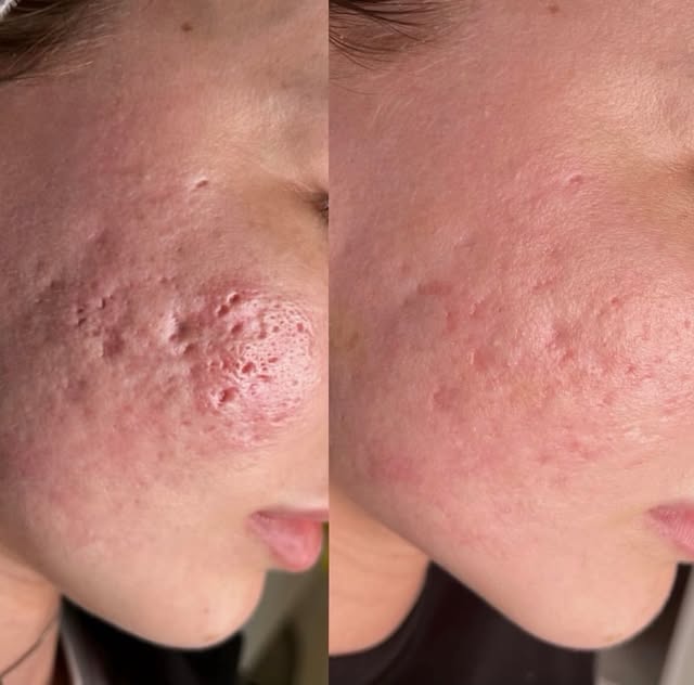 Progress 🔋
Acne scars aren’t treated with one thing.
They’re improved with the right combination.
S