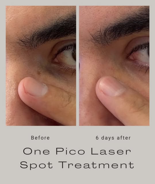 6 days later… 👀

Remember that stubborn pigment spot on the side of my nose? After one Pico spot tr