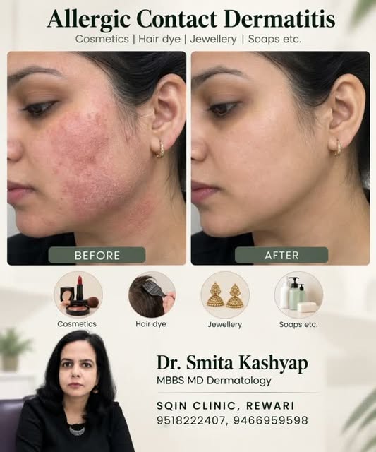 खुजली, लाल चकत्ते या जलन बार-बार हो रही है? 😣

कभी-कभी कोई cosmetic, perfume, hair dye, jewellery, 