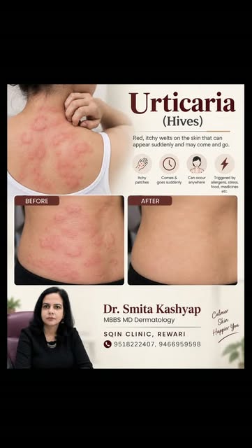 बार-बार शरीर पर लाल, उभरे हुए और खुजली वाले चकत्ते हो रहे हैं? 😣
यह Urticaria (पित्ती) हो सकती है।
