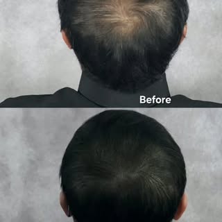 A gentleman in his 50s who joined us as a demo model experienced a complete transformation after thr